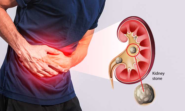 Common Symptoms of Kidney Stones